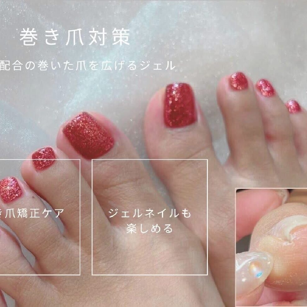 【10本全巻き爪矯正】ケア付き