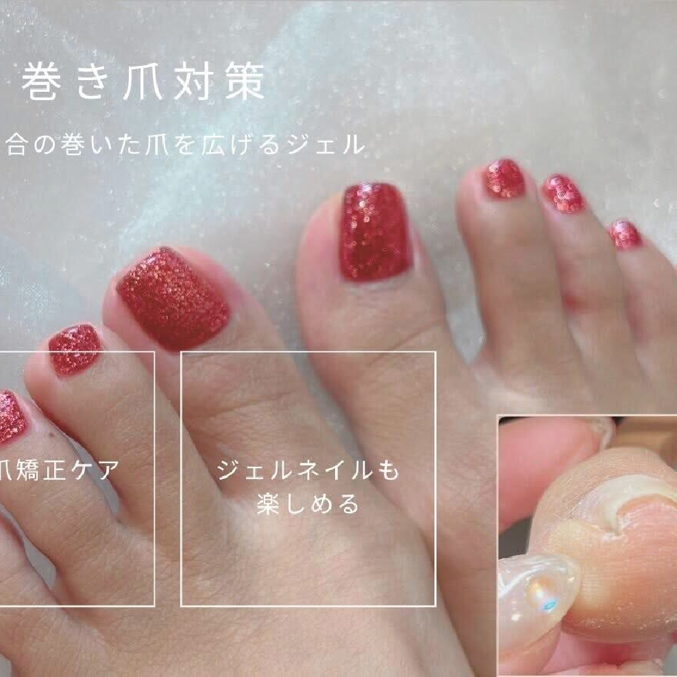 【親指巻き爪矯正】ケア付き