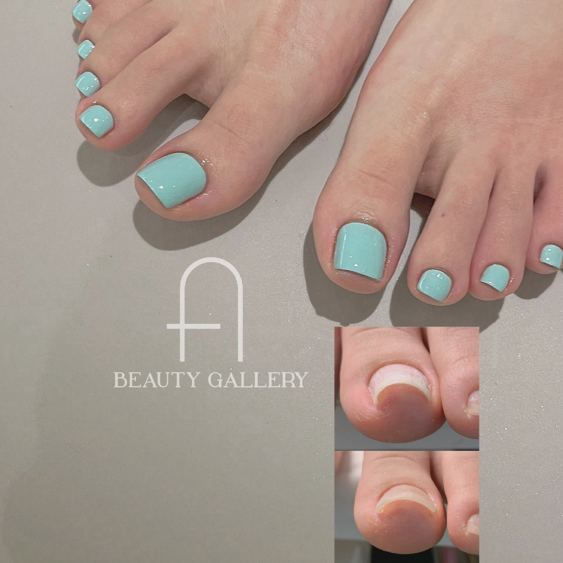 pedicur＊フット巻き爪矯正ワンカラー＊￥13000