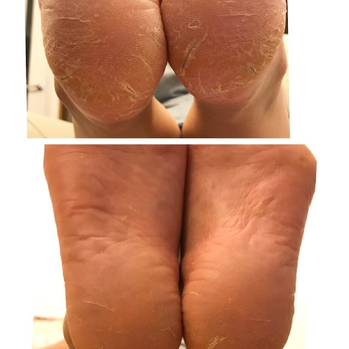 【フット】ファイル+甘皮ケア+角質ケア+トリートメント ￥6500