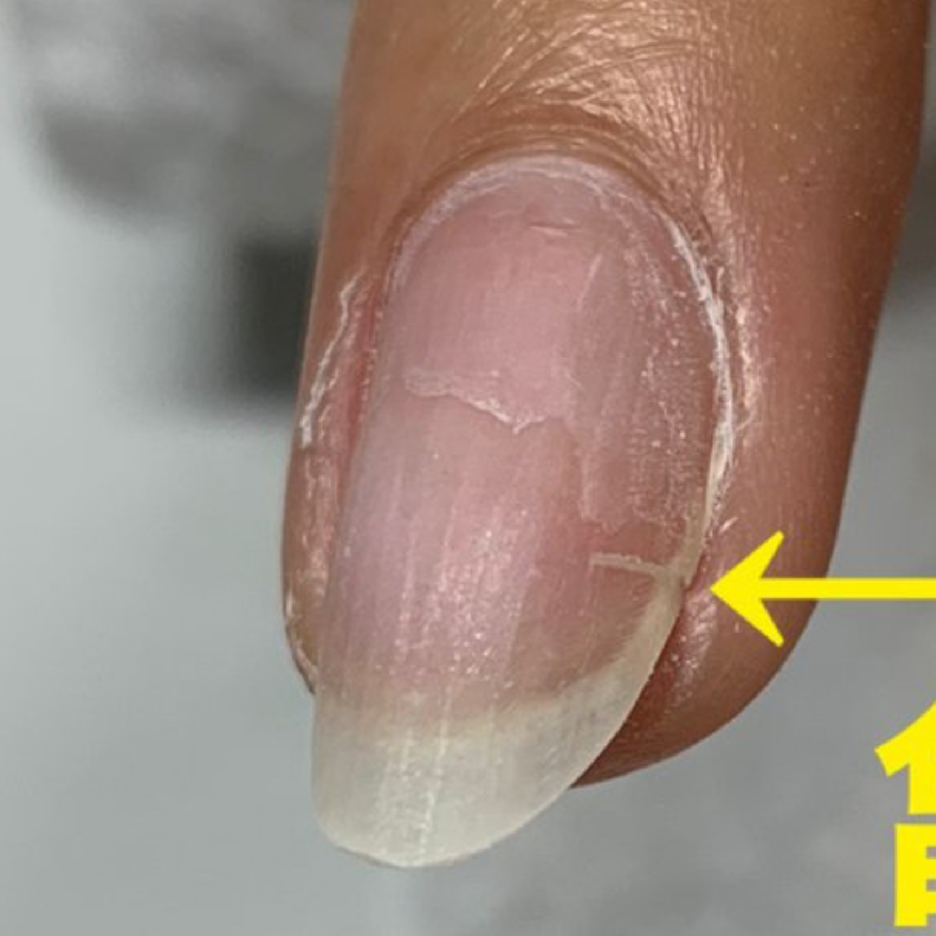 〈オプション〉亀裂補強　3本以内[1本¥550]