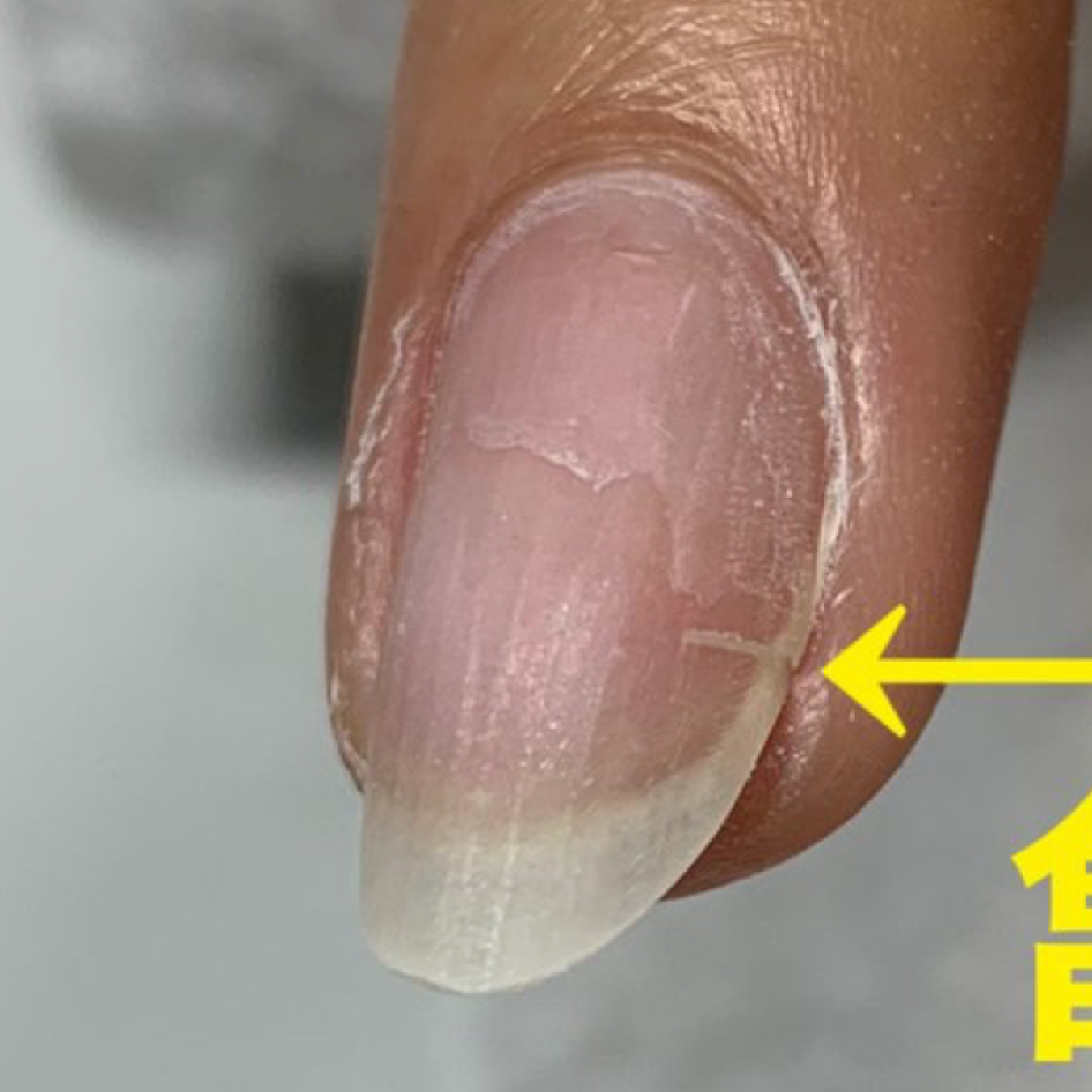 亀裂補強　3本以上[1本¥550]