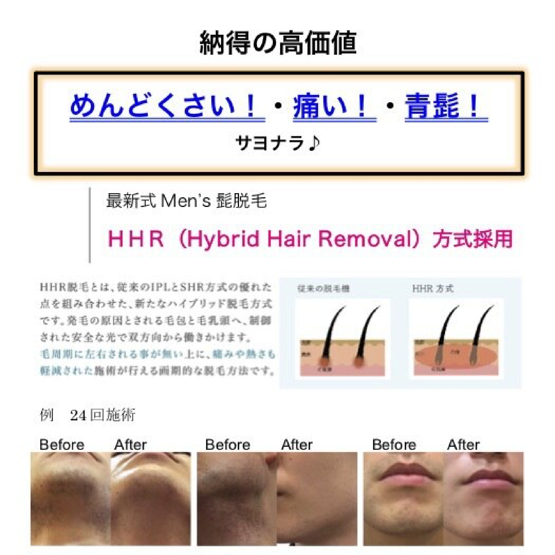 ☆匠カット＋メンズヒゲ脱毛☆いらないヒゲなくしましょう♪お得な年パスあり