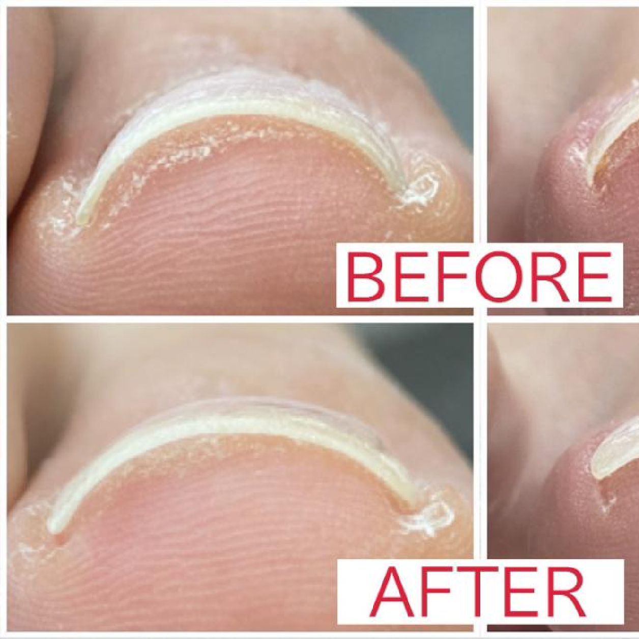 【1本】フット巻き爪改善コース●レジスタンスプレート