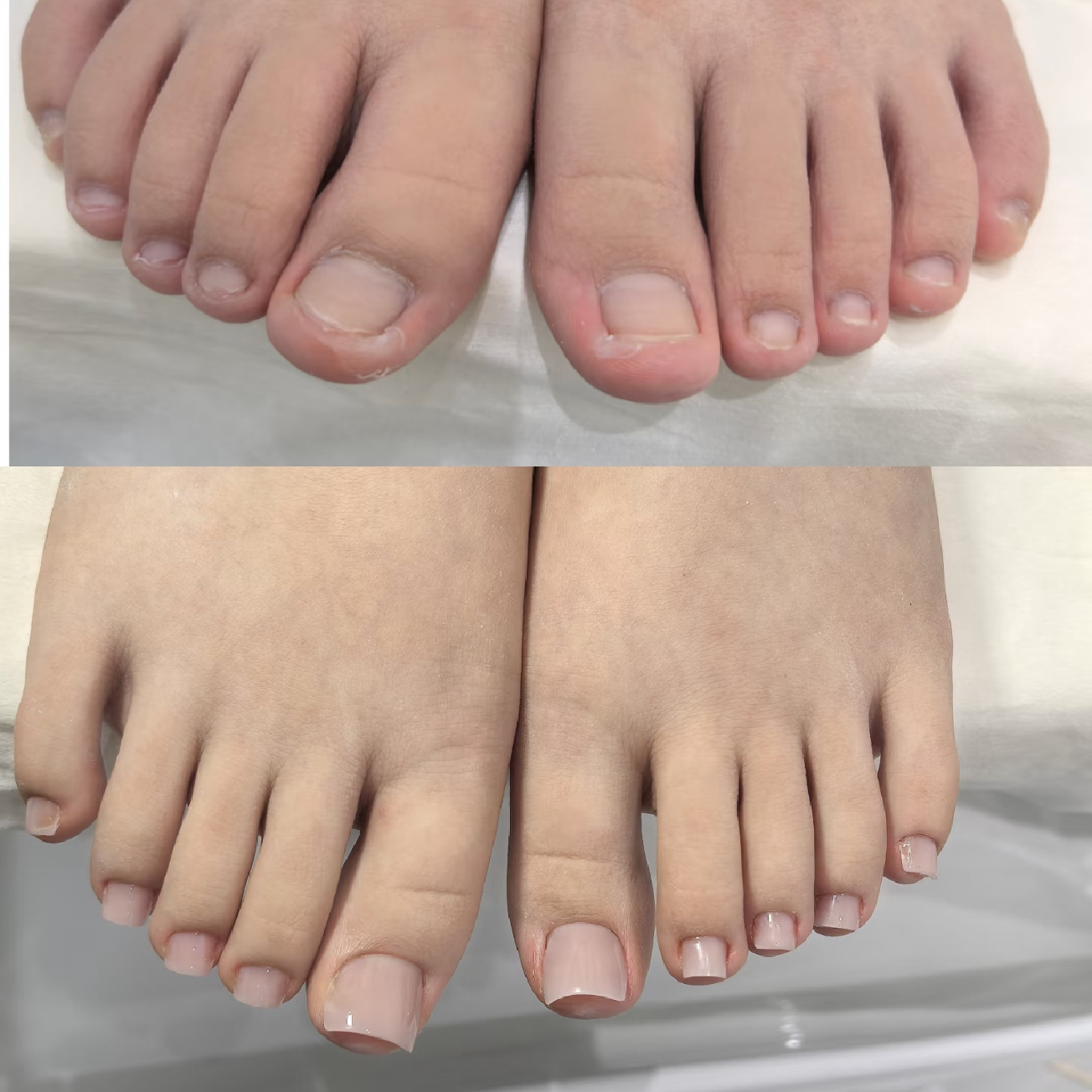 【フット深爪矯正】フット深爪矯正ワンカラー
