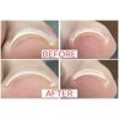 【1本】Foot巻き爪改善コース●レジスタンスプレート