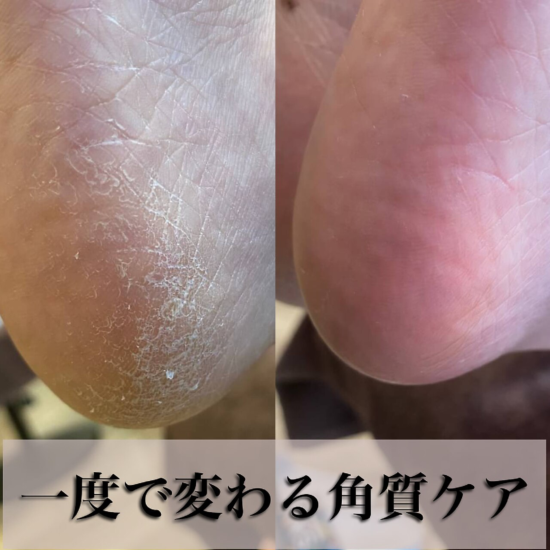 最新フット角質ケア◎１度で激変！ガサガサかかともツルツル赤ちゃん足に♪