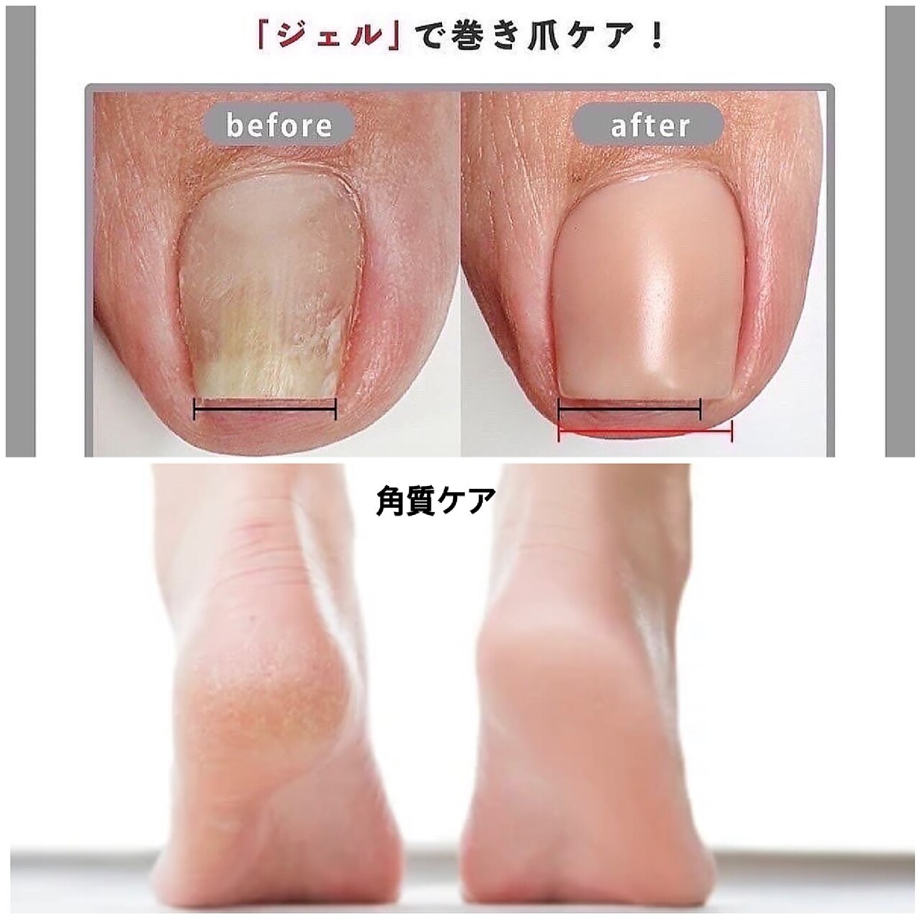 韓国より上陸☆【巻爪ケア】HeySwitch＆角質ケアスペシャルコース¥8400