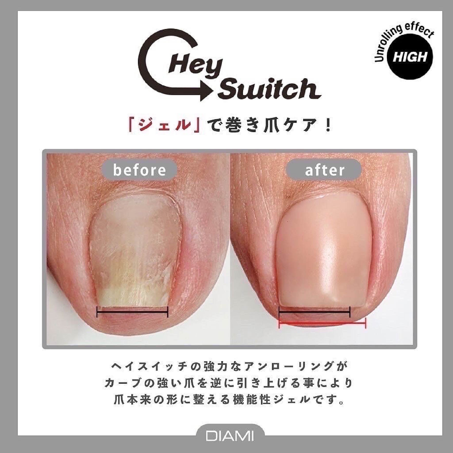 韓国より上陸☆話題の【巻爪ケア】Hey Switch