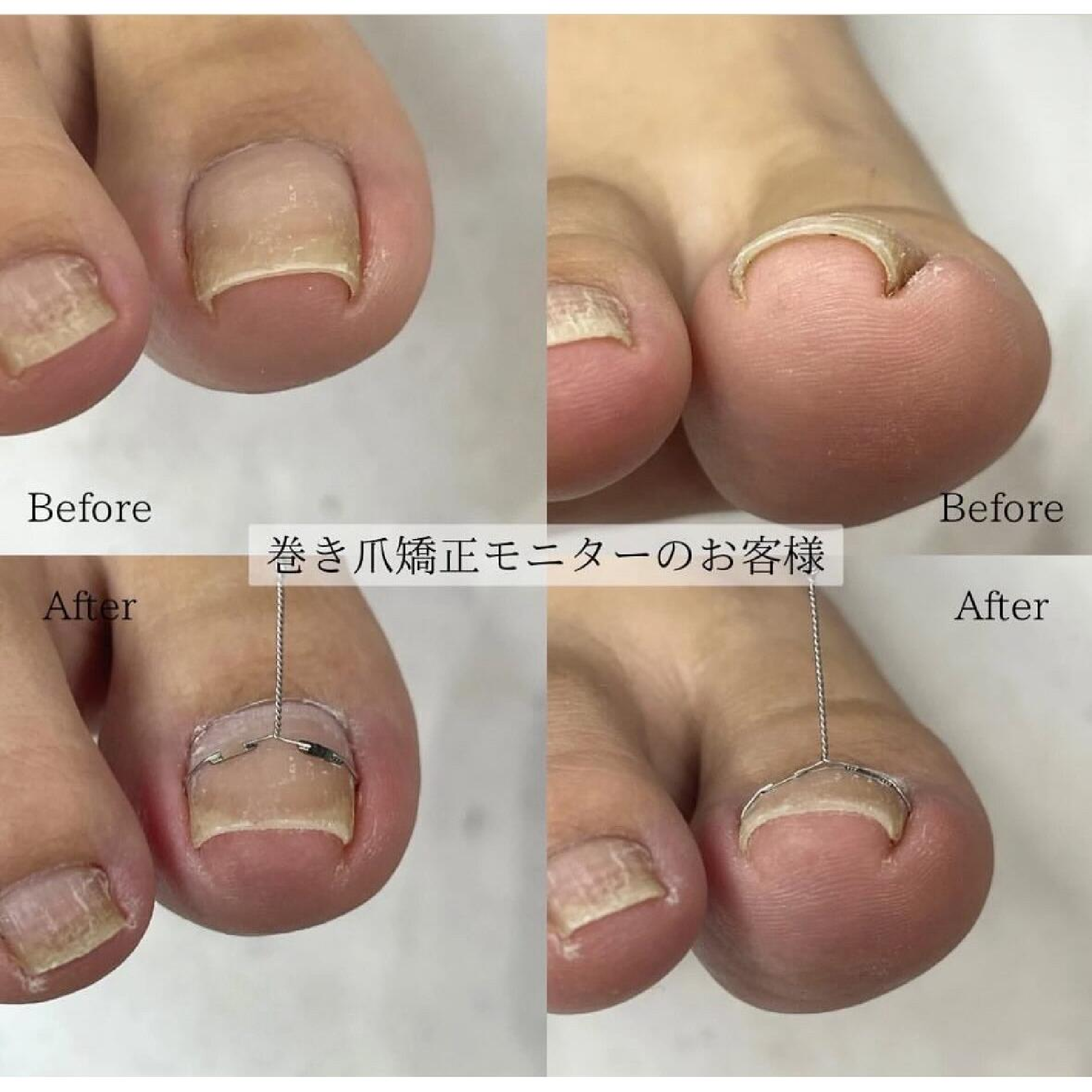 【巻き爪】巻き爪矯正◆¥11,000-